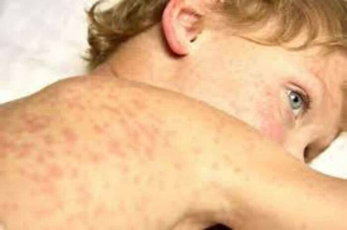 La sarna también aterriza en Madrid 2 sarna